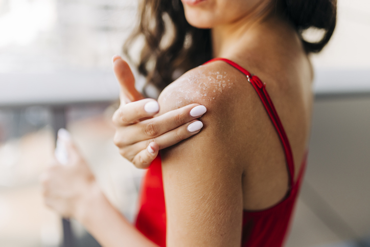 Vrouw heeft haar schouder verbrand